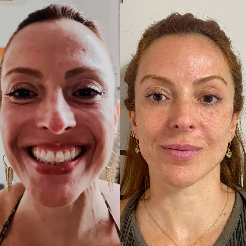 Resultado de harmonização facial — antes e depois, por Dra. Rozeane Leal
