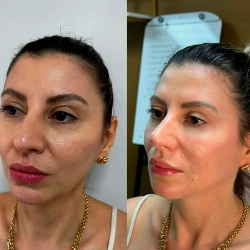 Resultado de preenchimento de contorno facial — antes e depois, por Dra. Rozeane Leal