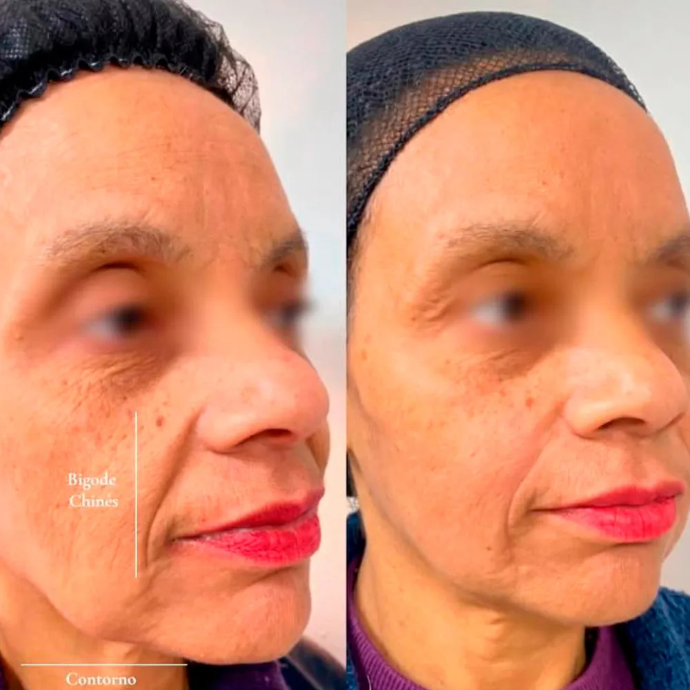 Resultado de harmonização facial — antes e depois, por Dra. Rozeane Leal