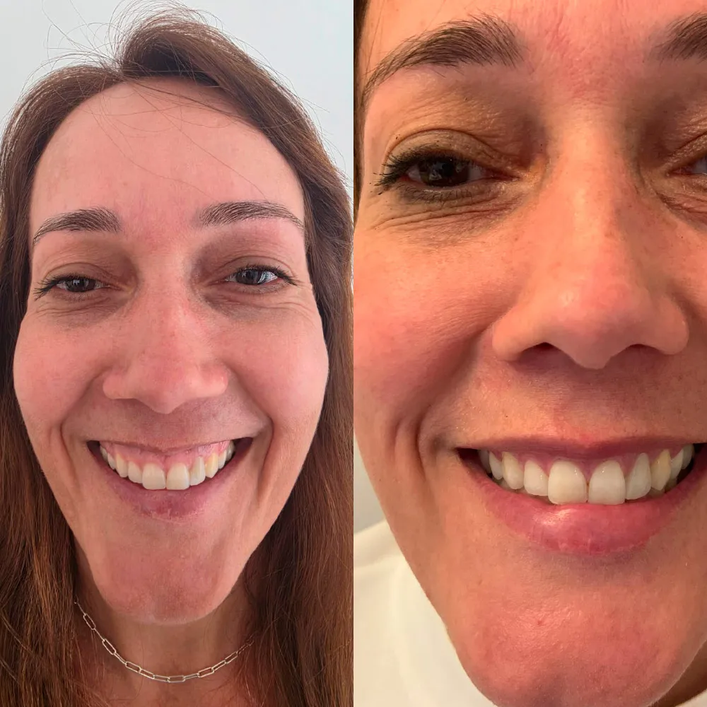 Resultado de correção de sorriso gengival — antes e depois, por Dra. Rozeane Leal