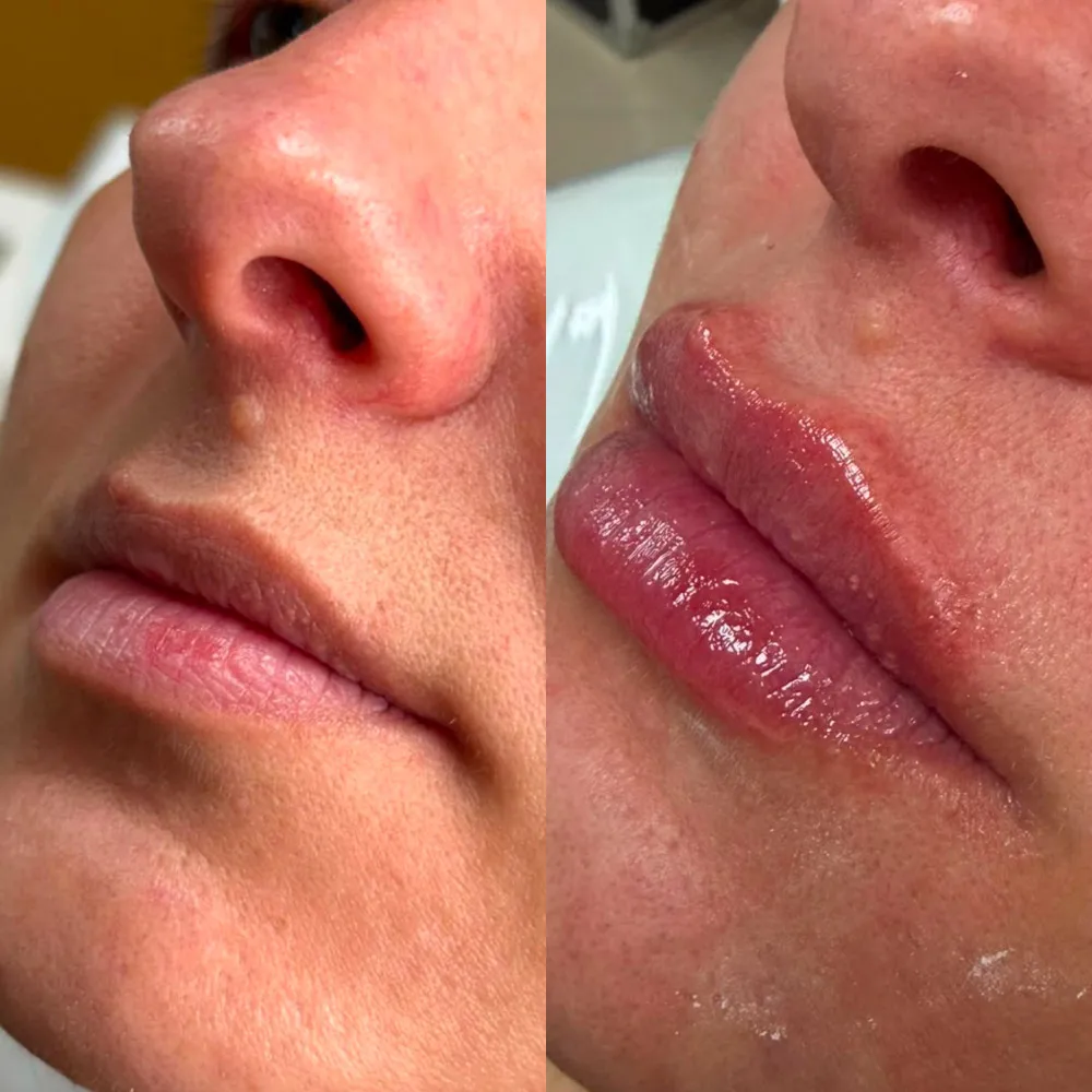 Resultado de harmonização labial — antes e depois, por Dra. Rozeane Leal