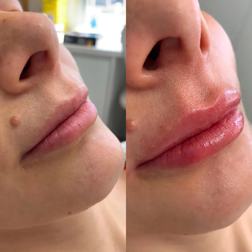Resultado de preenchimento labial — antes e depois, por Dra. Rozeane Leal