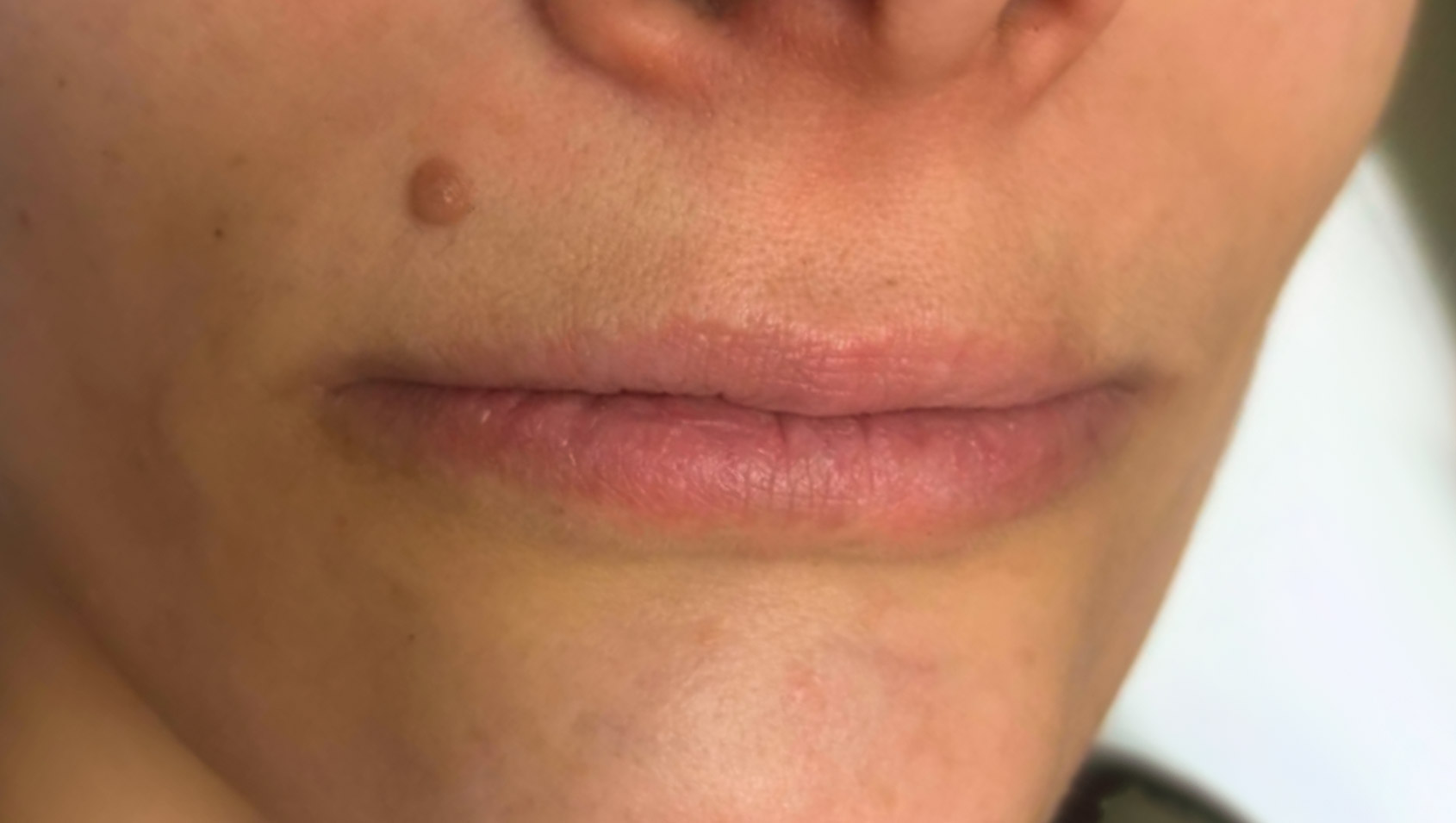 Antes — harmonização labial pela Dra. Rozeane Leal em São Paulo