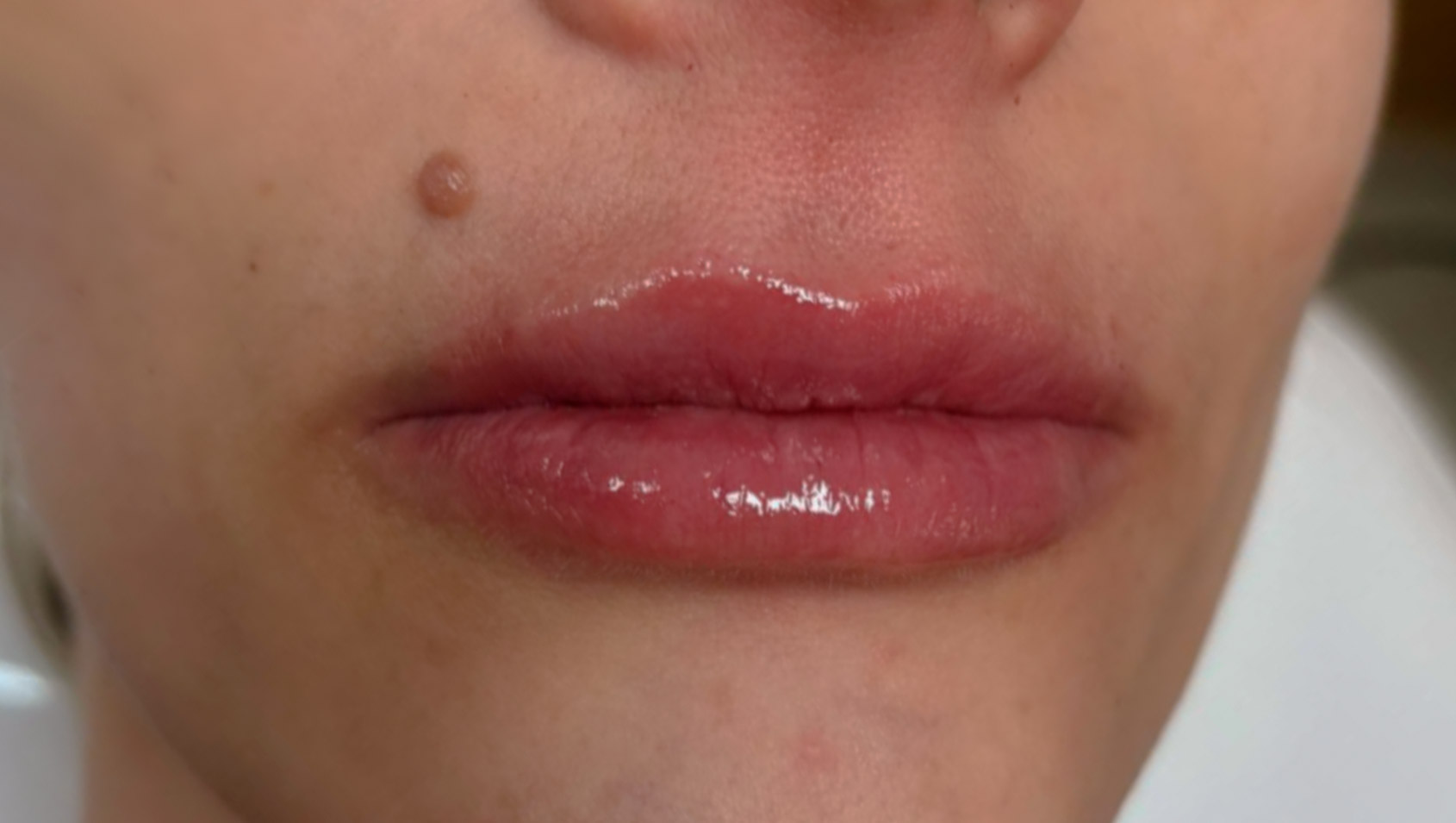 Depois — harmonização labial e preenchimento labial pela Dra. Rozeane Leal